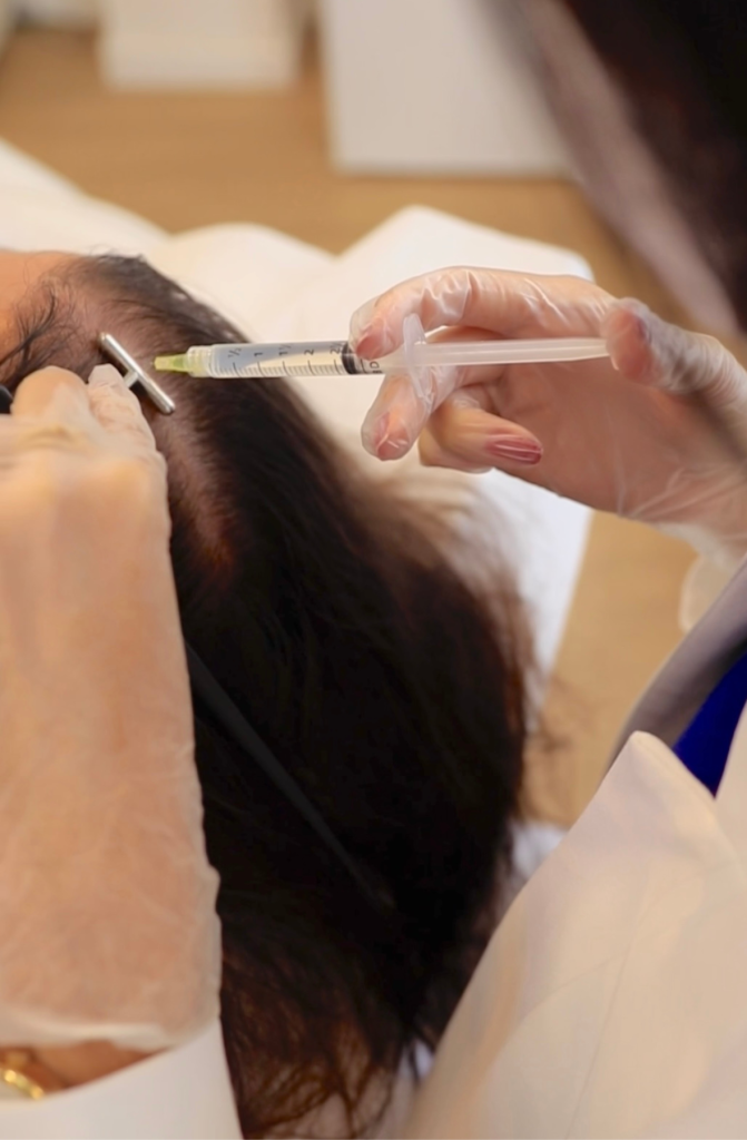 Mesoterapia para queda de cabelo