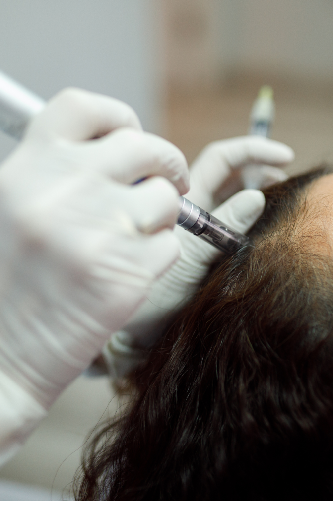 Microagulhamento​ capilar para queda de cabelo